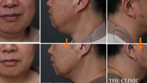 顔の脂肪吸引でここまで変わる! ～ある男性モニターの場合～