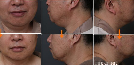 顔の脂肪吸引でここまで変わる! ～ある男性モニターの場合～