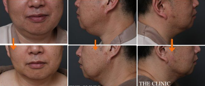 顔脂肪吸引の術前後の変化