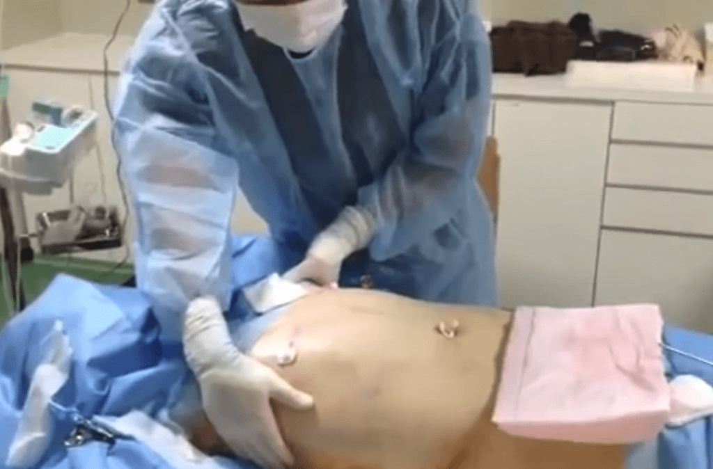 男性のお腹まわりのベイザー脂肪吸引で、注意すべきポイント