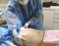 男性のお腹まわりのベイザー脂肪吸引で、注意すべきポイント