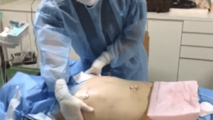 男性のお腹まわりのベイザー脂肪吸引で、注意すべきポイント