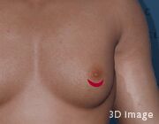 真性女性化乳房の、手術時の切開箇所