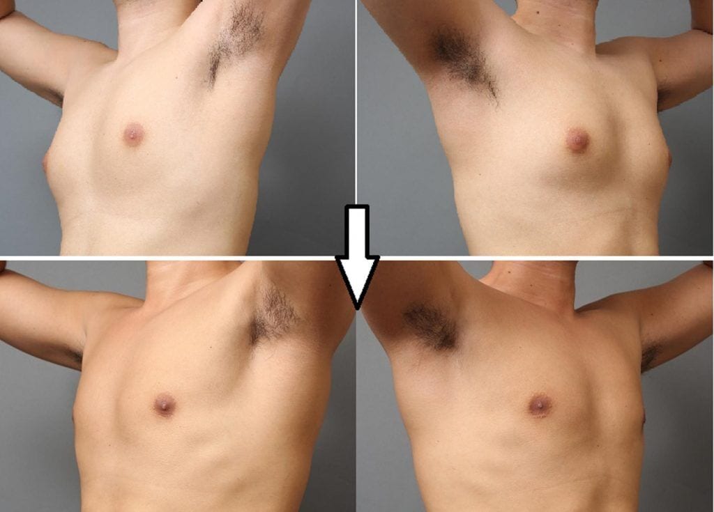 女性化乳房と言われたら読んで欲しい～原因と治療法の解説～