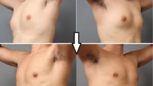 女性化乳房と言われたら読んで欲しい～原因と治療法の解説～