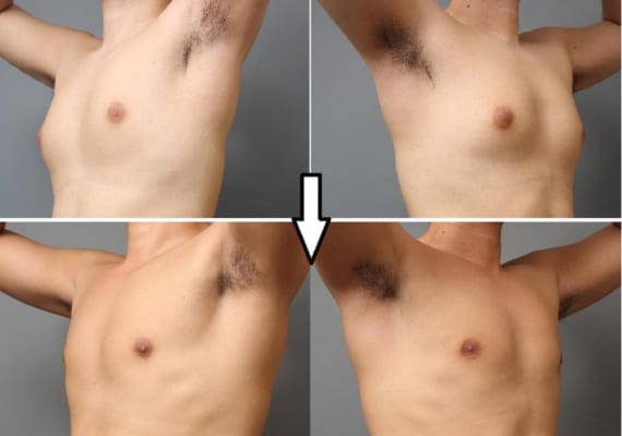 女性化乳房と言われたら読んで欲しい～原因と治療法の解説～