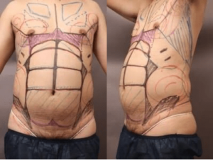 男性脂肪吸引のマーキング