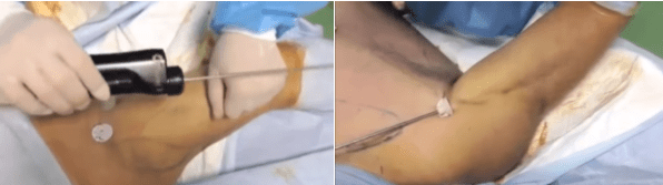 パワーエックスによる二の腕の脂肪吸引