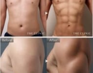 男性には、男性のための脂肪吸引を! 実例と経過をご紹介