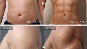 男性には、男性のための脂肪吸引を! 実例と経過をご紹介