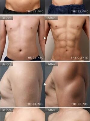 男性には、男性のための脂肪吸引を! 実例と経過をご紹介