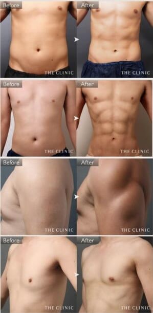 男性の脂肪吸引症例