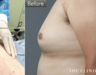 男性の脂肪吸引で苦労するのは脂肪の硬さ! その解決法とは?