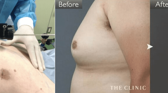 男性の脂肪吸引で苦労するのは脂肪の硬さ! その解決法とは?