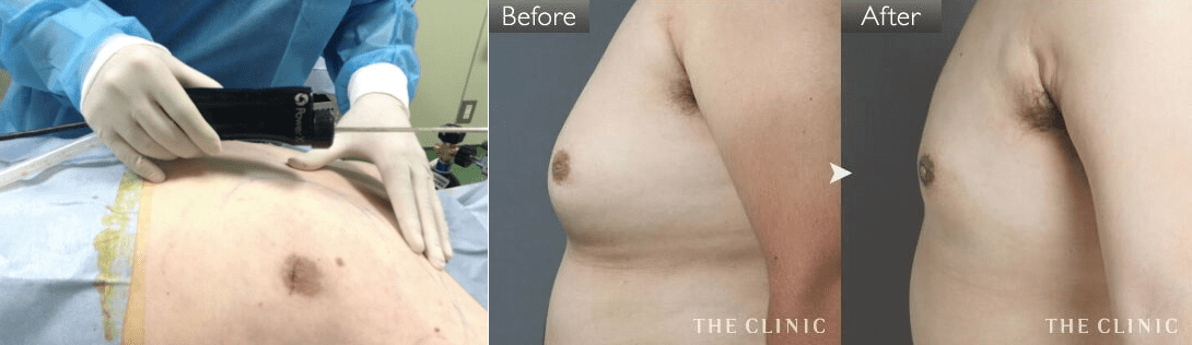 パワーエックスによる女性化乳房の脂肪吸引