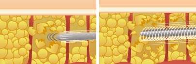 通常の脂肪吸引とパワーエックスの違い