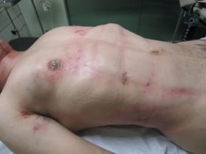 脂肪吸引直後の様子(男性)