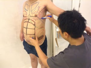 脂肪吸引前のマーキング(男性)