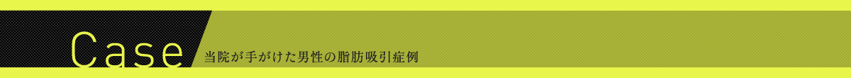 Case 当院が手がけた男性の脂肪吸引症例