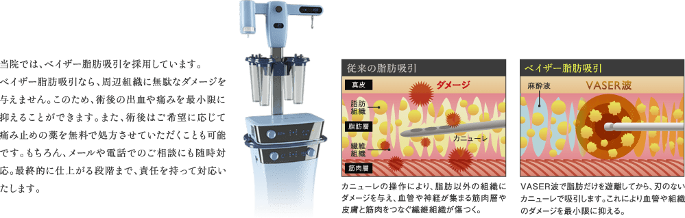 for Pain | 痛み対策 | 当院では、ベイザー脂肪吸引を採用しています。ベイザー脂肪吸引なら、周辺組織に無駄なダメージを与えません。このため、術後の出血や痛みを最小限に抑えることができます。また、術後はご希望に応じて痛み止めの薬を無料で処方させていただくことも可能です。もちろん、メールや電話でのご相談にも随時対応。最終的に仕上がる段階まで、責任を持って対応いたします。