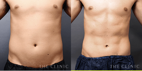 腹部／腰 の症例1