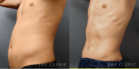 腹部/腰 の症例2