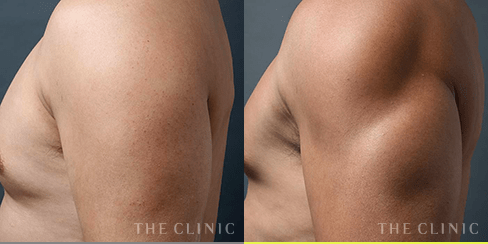 二の腕 の症例1