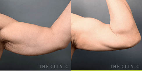 二の腕 の症例2