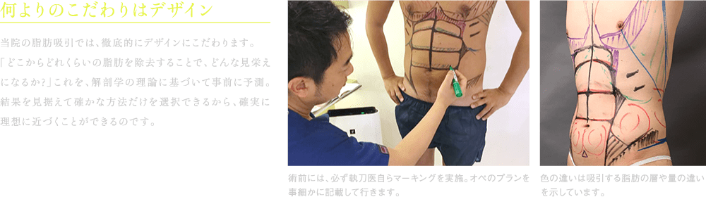 何よりのこだわりはこのデザイン | 当院の脂肪吸引では、徹底的にデザインにこだわります。「どこからどれくらいの脂肪を除去することで、どんな見栄えになるか?」これを、解剖学の理論に基づいて事前に予測。結果を見据えて確かな方法だけを選択できるから、確実に理想に近づくことができるのです。