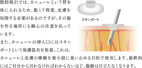 脂肪吸引では、カニューレという管を体に入れるため、数ミリ程度、皮膚を切開する必要があるのですが、その傷を作る場所にも細心の注意を払っています。また、カニューレの挿入口にはスキンポートという保護器具を装着。これは、カニューレと皮膚の摩擦を最小限に食い止める目的で使用します。最終的にはご自分から言わなければわからないほど、傷跡は目立たなくなります。