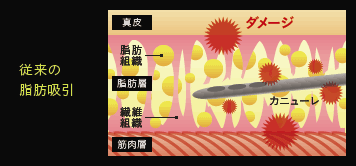 従来の脂肪吸引