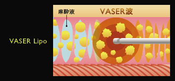 VASER Lipo