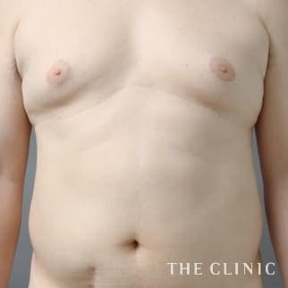 女性化乳房のベイザーのモニター（男性48歳）術前症例画像