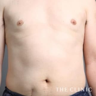 女性化乳房のベイザーのモニター（男性48歳）術後症例画像
