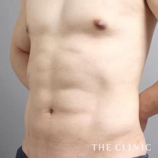 SIXPACK 陰影のある腹筋のベイザー4Dスカルプトのモニター(男性45歳)術後症例画像