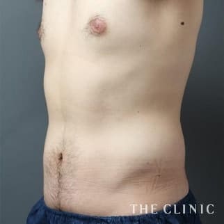 腹部のベイザーのモニター(男性28歳)術後症例画像