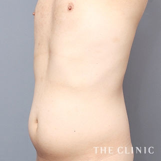 腹部のベイザーのモニター（男性32歳）術前症例画像