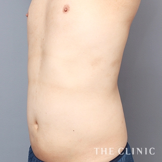 腹部のベイザーのモニター（男性32歳）術後症例画像