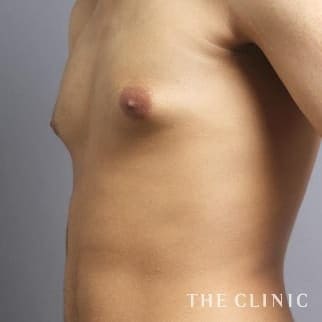 女性化乳房のベイザーのモニター(男性20歳)術前症例画像