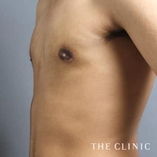 女性化乳房のベイザーのモニター（男性20歳）術後症例画像