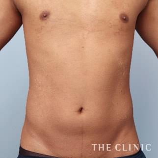 腹部のベイザーのモニター（男性27歳）術前症例画像