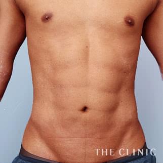 腹部のベイザーのモニター(男性27歳)術後症例画像