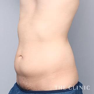 腹部のベイザーのモニター(男性26歳)術前症例画像