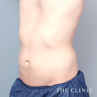 腹部のベイザーのモニター(男性26歳)術後症例画像