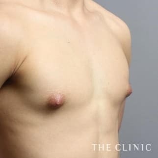 女性化乳房のベイザーのモニター（男性19歳）術前症例画像