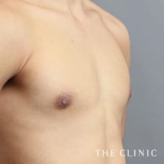女性化乳房のベイザーのモニター（男性19歳）術後症例画像
