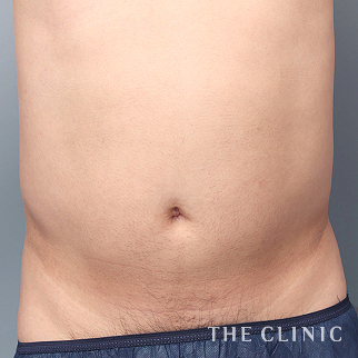 腹部のベイザーのモニター（男性36歳）術前症例画像