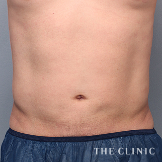 腹部のベイザーのモニター（男性36歳）術後症例画像