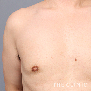 女性化乳房のベイザーのモニター(男性33歳)術後症例画像