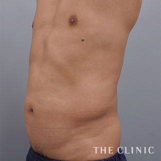 腹部のベイザーのモニター（男性57歳）術前症例画像